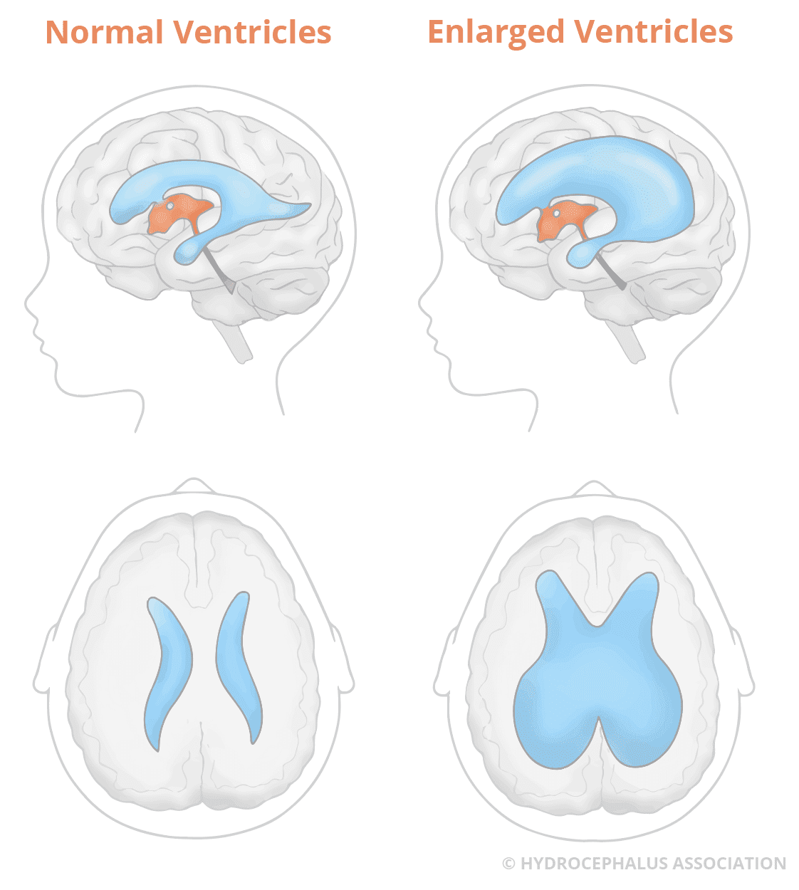 How Long is Normal Life Expectancy With Hydrocephalus: Essential Facts