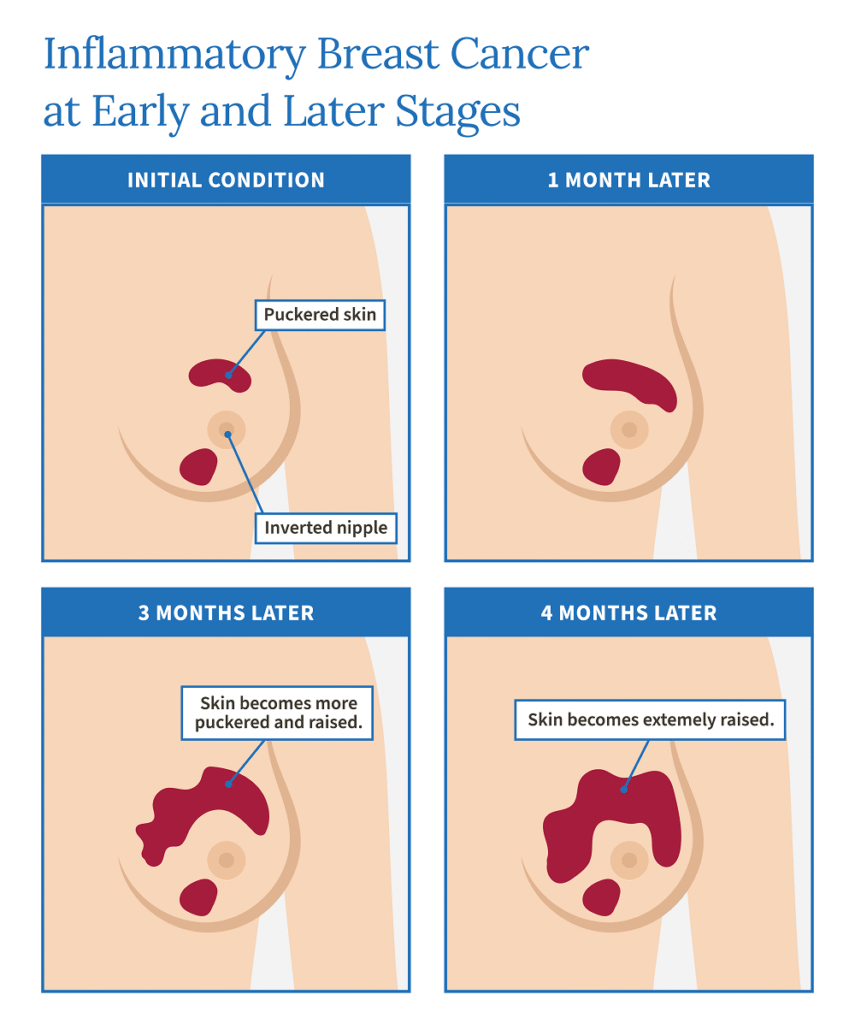 BREAST CANCER AWARENESS: KNOWLEDGE,EARLY DETECTION,AND HOPE. 4 image 3