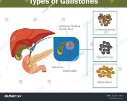 8. Treatment for High Bilirubin in the Blood: Causes, Medical Care, and How to Control It 3 image 4