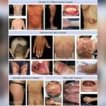 Skin Diseases