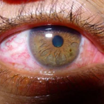 Eye Symptoms Caused by Using Your Phone for Too Long at Night